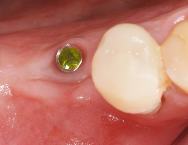 Klinische Situation mit BioniQ S2.9 Implantat im Frontzahnbereich