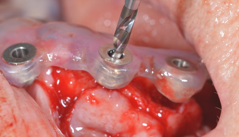 Schablonengeführte Chirurgie für BioniQ S2.9 Implantate